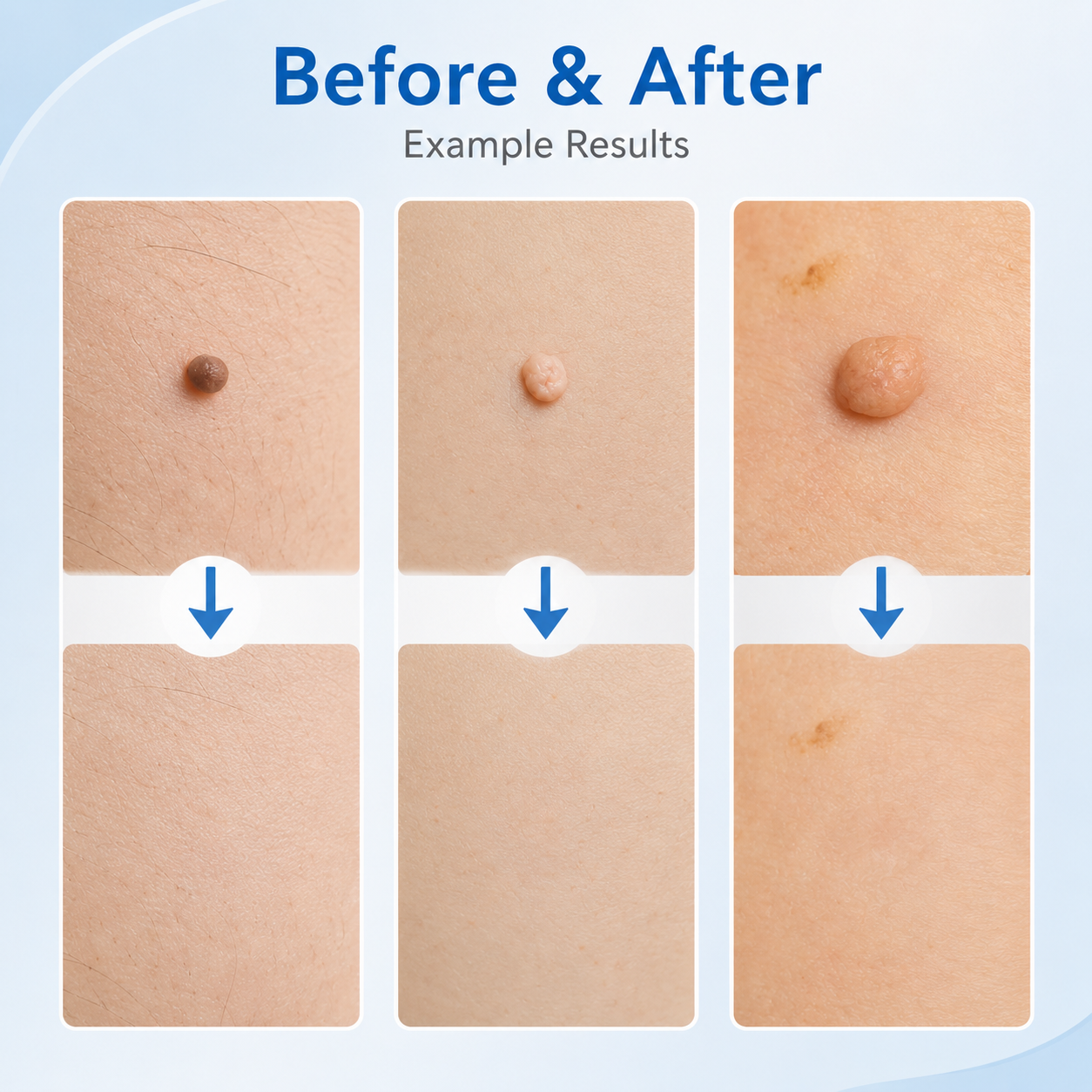 𩹠Skin Tag Removal Kit â 2-in-1 Auto Band Applicator with Dual Size Options for At-Home Use